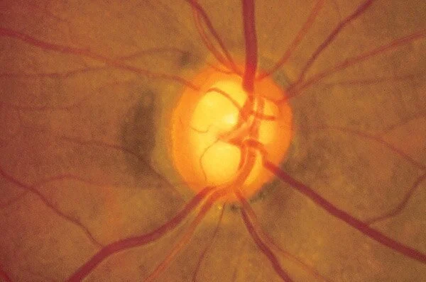 Glaucoma Screening